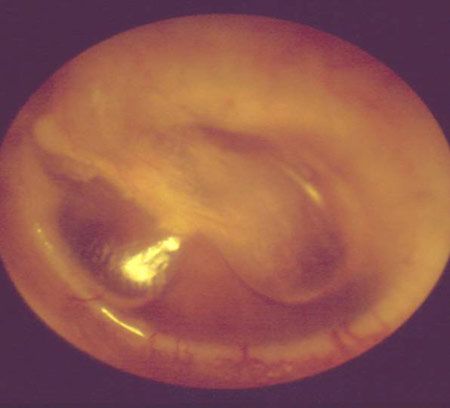 Serous otitis media 